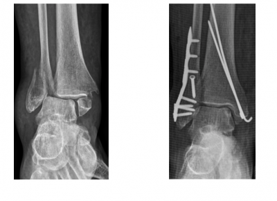 Fracture Bi Mall Olaire Dr Bovier Lapierre