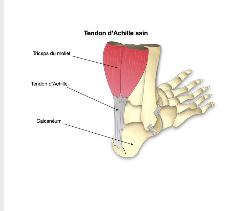 Rupture Fraiche Du Tendon D Achille Dr Bovier Lapierre