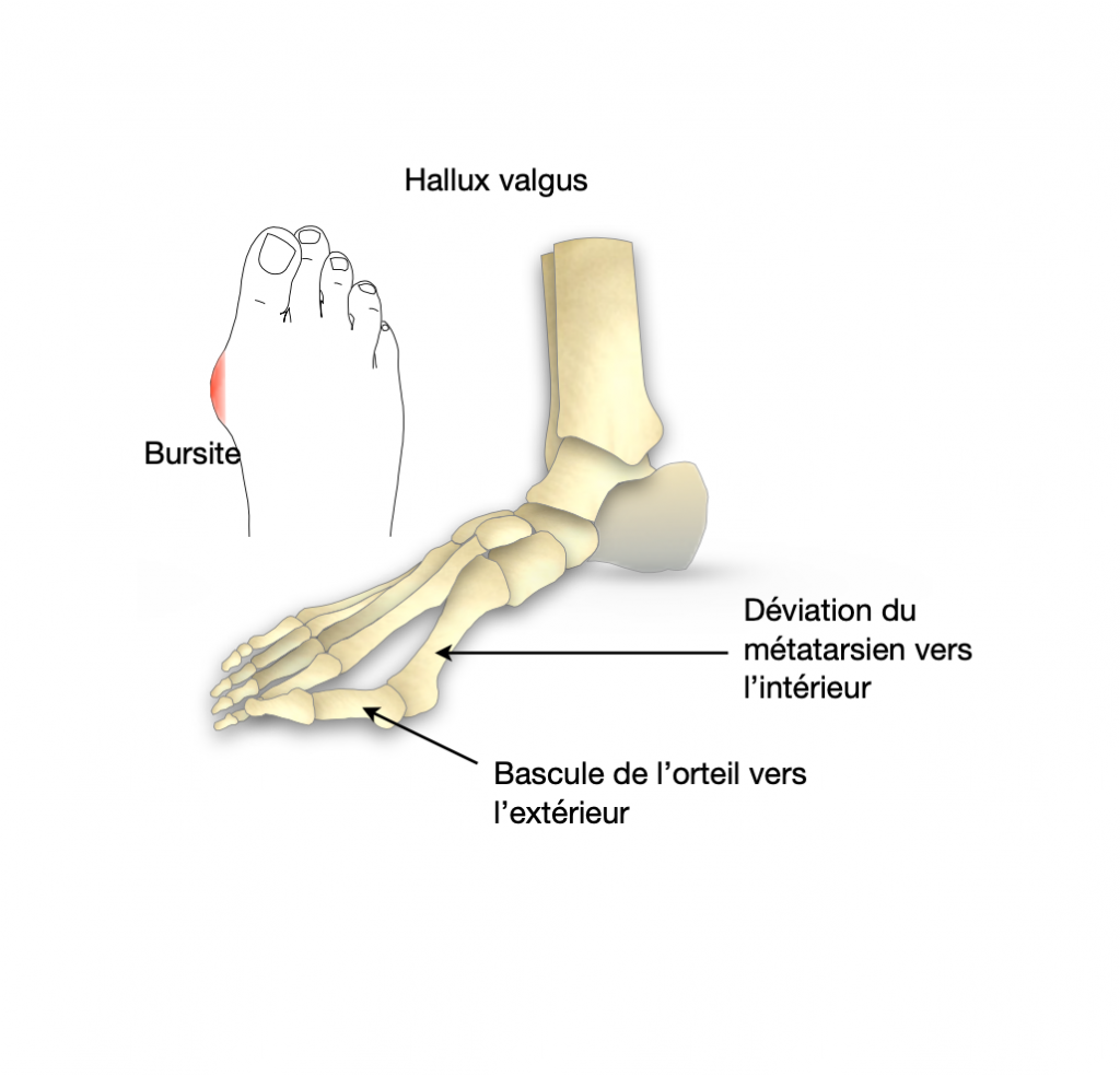 Hallux valgus sévère Dr Bovier Lapierre