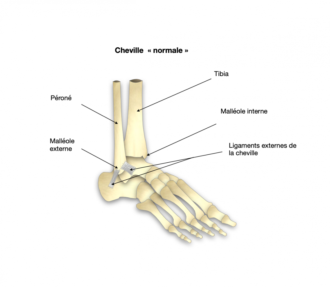 Fracture bi malléolaire Dr Bovier Lapierre