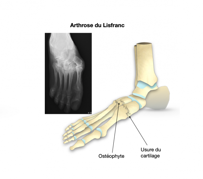 Arthrose de la cheville - Dr Bovier-Lapierre