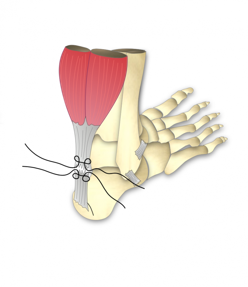 Rupture Fraiche Du Tendon D'Achille - Dr Bovier-Lapierre